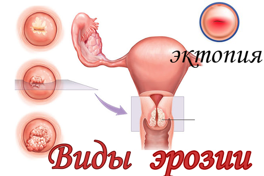 Виды эрозий шейки матки